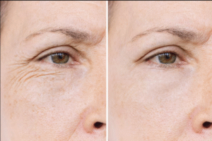 Rugas no Rosto o que fazer