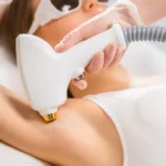 depilação a laser como funciona e quanto custa