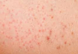 Calça legging causa foliculite?