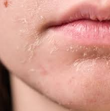 Pele ressecada o que fazer