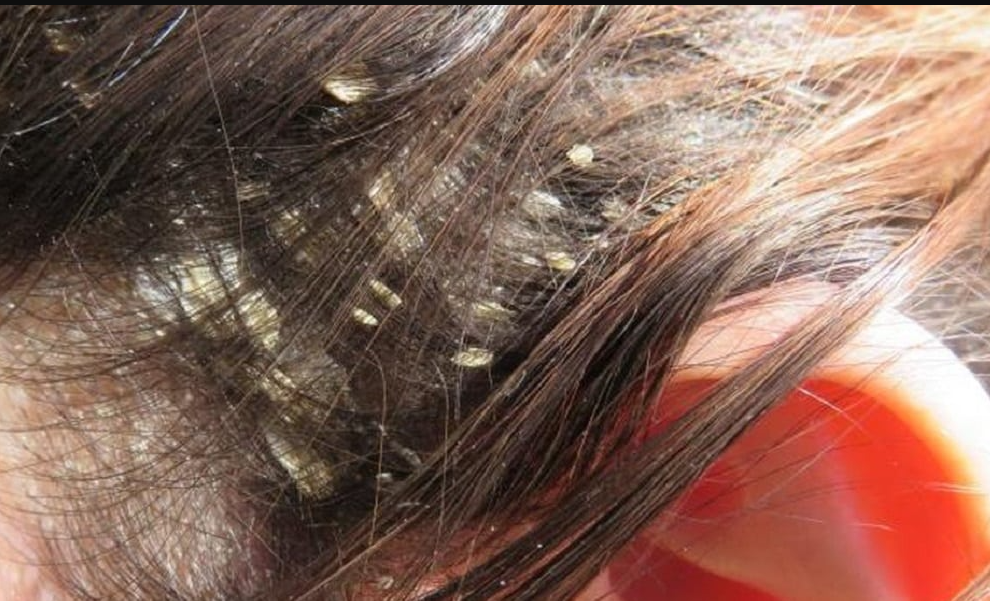 Receita caseira para caspa (3 receitas)