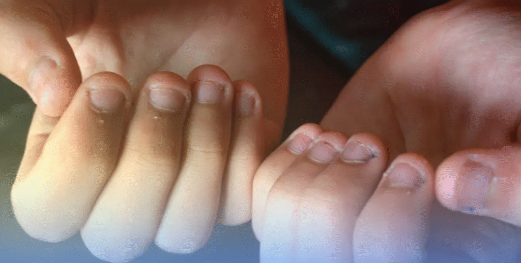 Dicas para parar de roer unhas