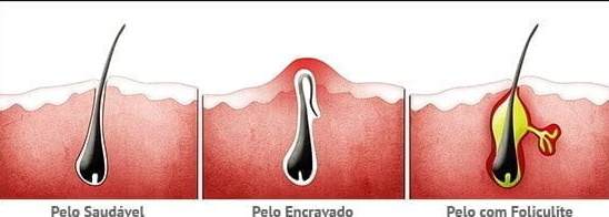 Calça legging causa foliculite?