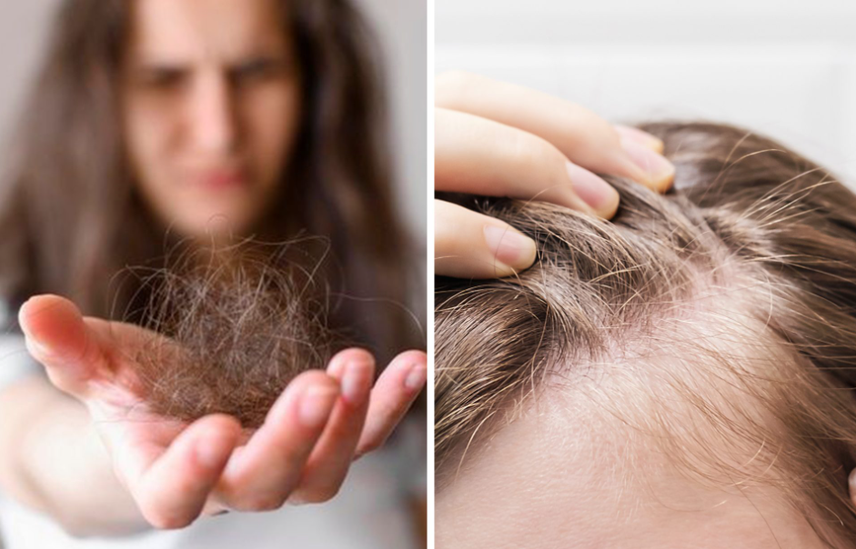 5 Receita caseira para queda de cabelo rápido!