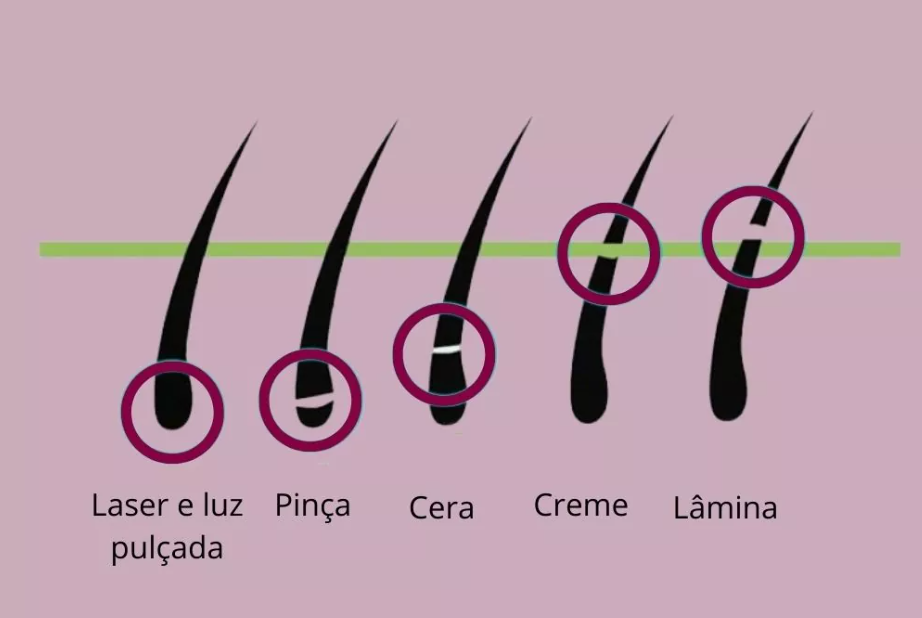 Depilação como funciona