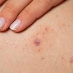 Calça legging causa foliculite?