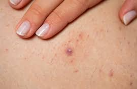 Calça legging causa foliculite?