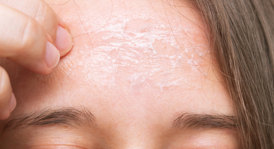 Pele ressecada o que fazer, pele do rosto.