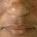 Por que a pele escurece na gravidez? 5 Motivos