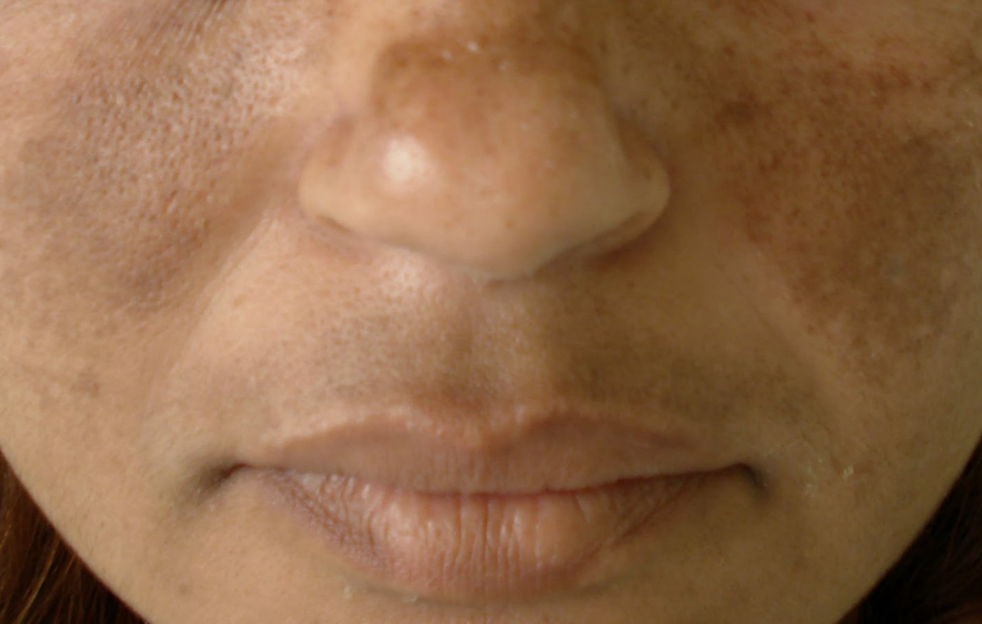 Por que a pele escurece na gravidez? 5 Motivos