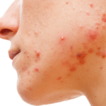 SKIN CARE PARA PELE OLEOSA E ACNEICA