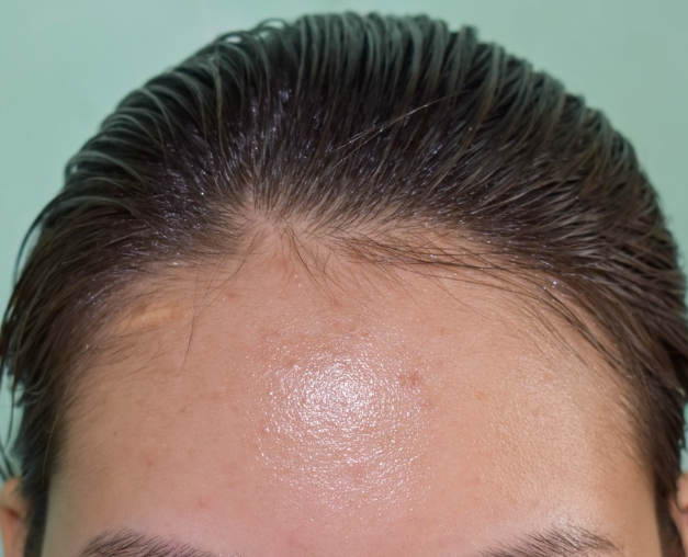 PELE OLEOSA O QUE FAZER? 6 CUIDADOS