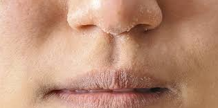 Pele ressecada o que fazer? 5 erros que você faz sem saber