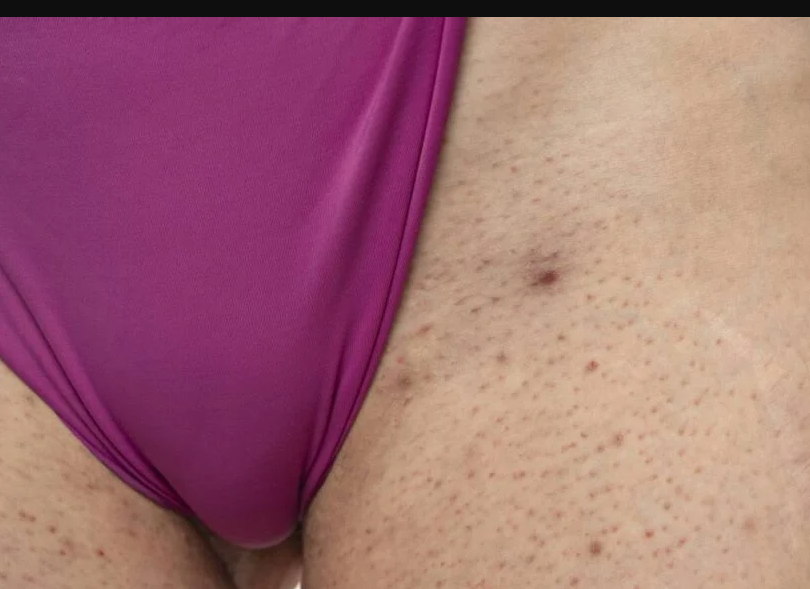 Por que a virilha fica escura? 6 Motivos