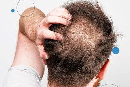 5 Receita caseira para queda de cabelo rápido!