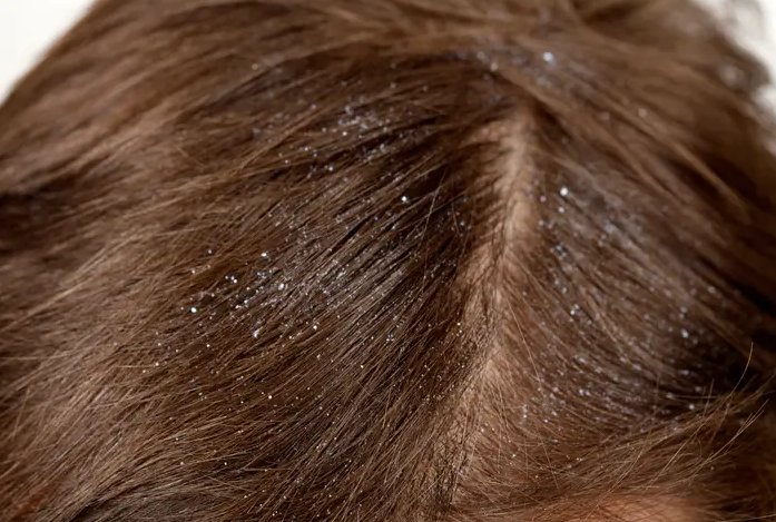 Receita caseira para caspa (3 receitas)