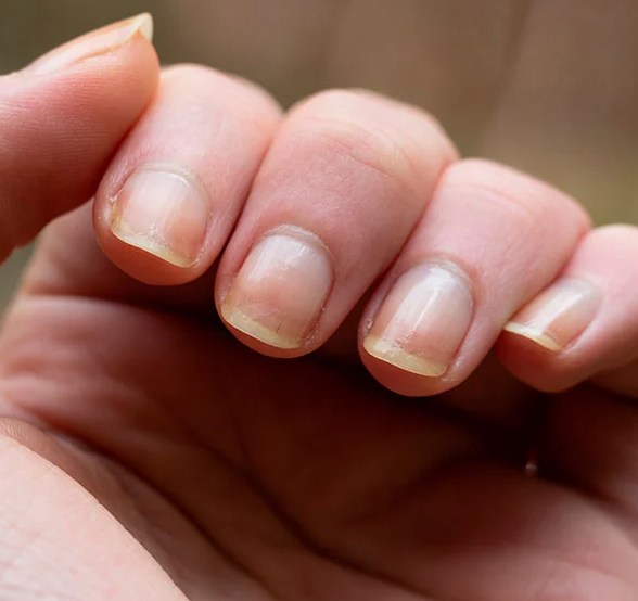 Por que a unha fica amarela? 3 motivos