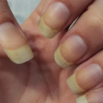 Por que a unha fica amarela? 3 motivos