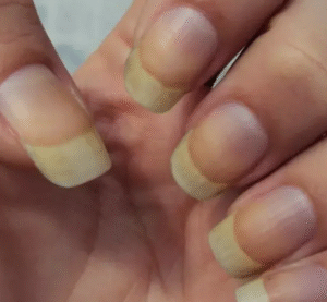 Por que a unha fica amarela? 3 motivos