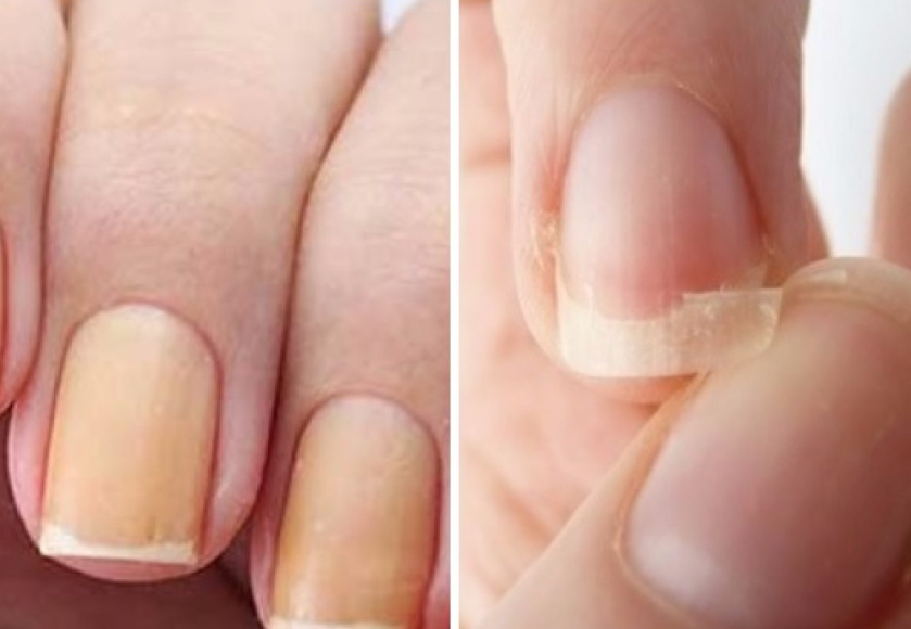 Por que a unha fica amarela? 3 motivos